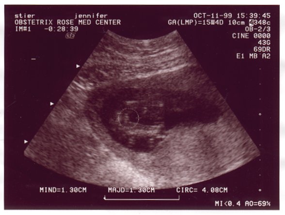 Ultrasound Picture No. 1