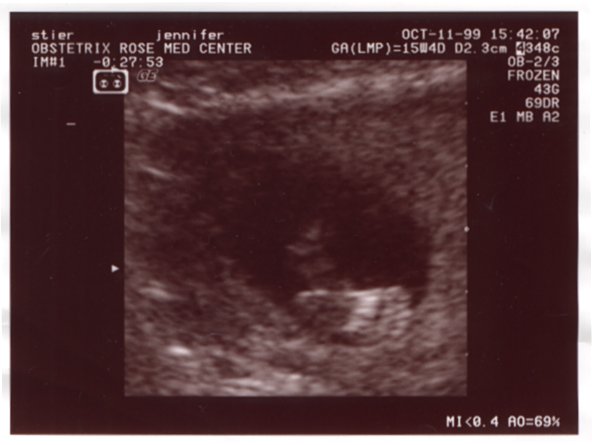 Ultrasound Picture No. 2