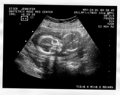 Ultrasound Picture