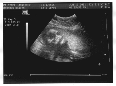 Ultrasound Picture